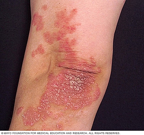 Psoriasis Treatment