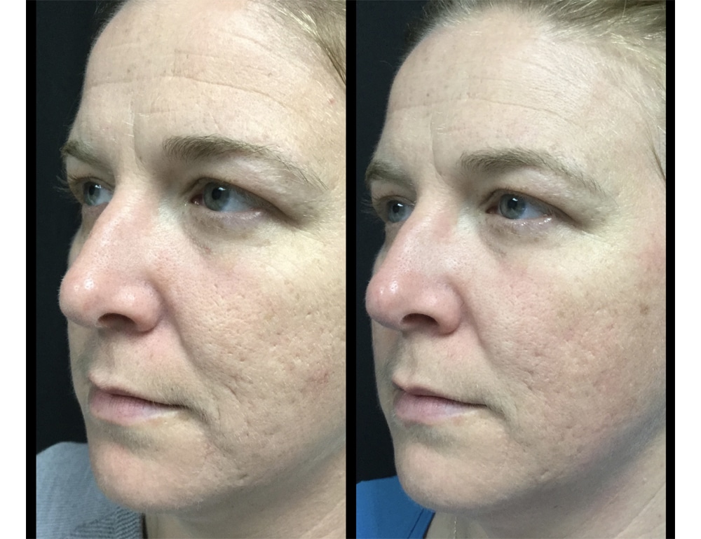 acne scar treatment