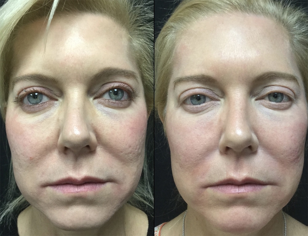 acne scar treatment