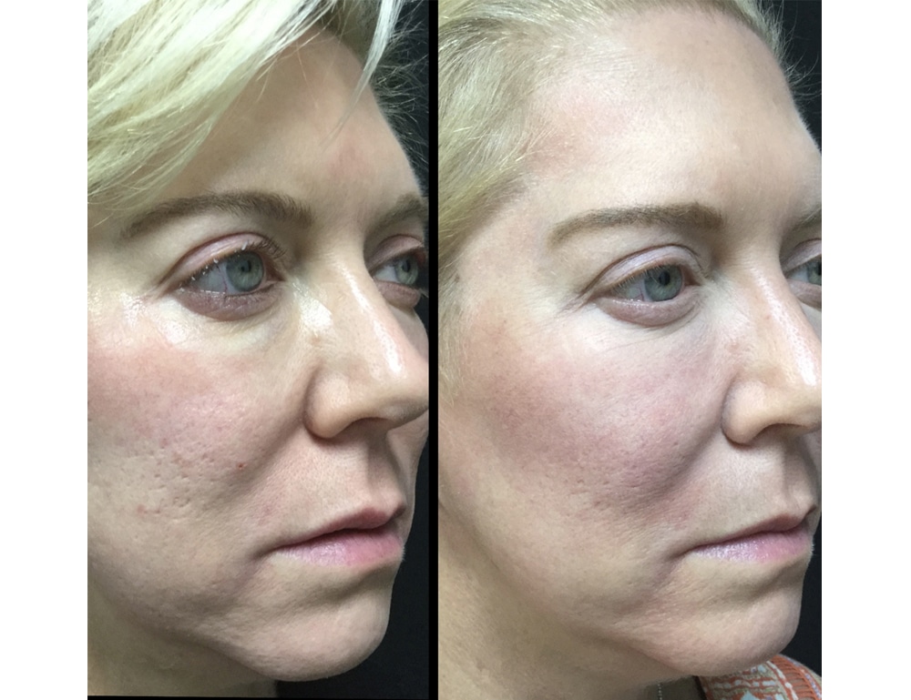 acne scar treatment